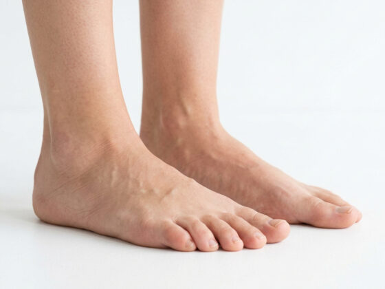 평발 발바닥 통증 아치서포트 깔창 필요 증상